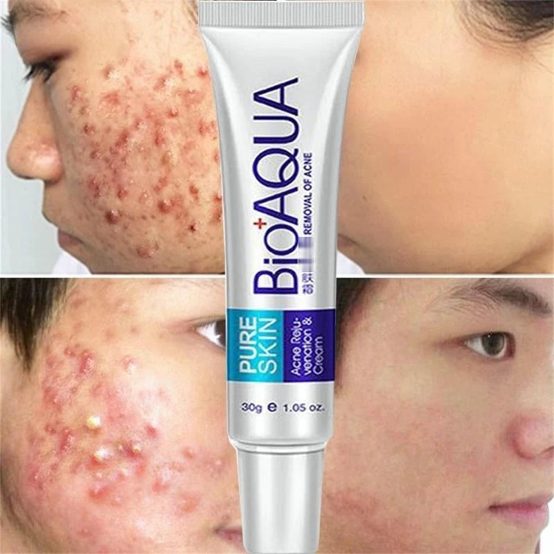 CREMA ANTIACNE ESPINILLA BIOAQUA